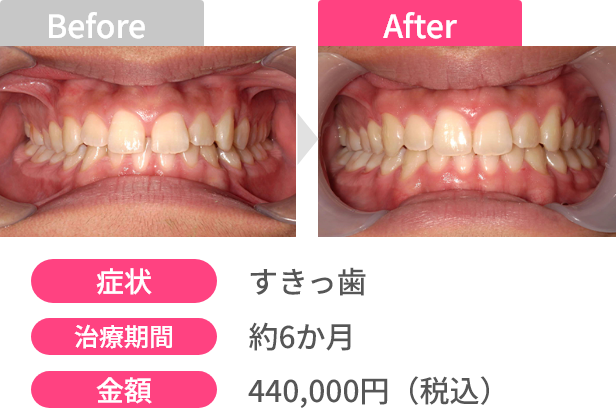 Before After 画像4 - あっという間に変わる！オーダーメイドスピード矯正 | 新美歯科