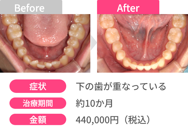 Before After 画像5 - あっという間に変わる！オーダーメイドスピード矯正 | 新美歯科